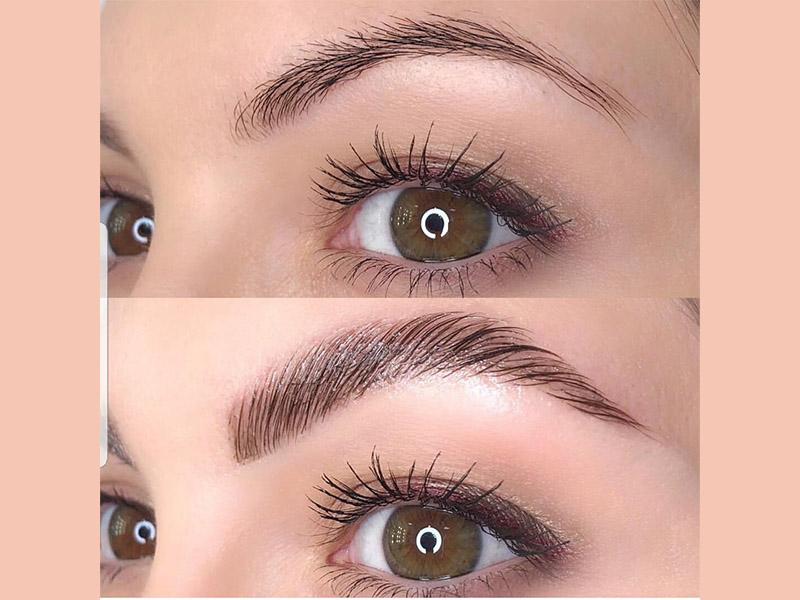 Browlift Saint-Quentin